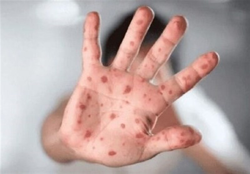 , موردی از بیماری آبله میمون در کشور مشاهده نشده است