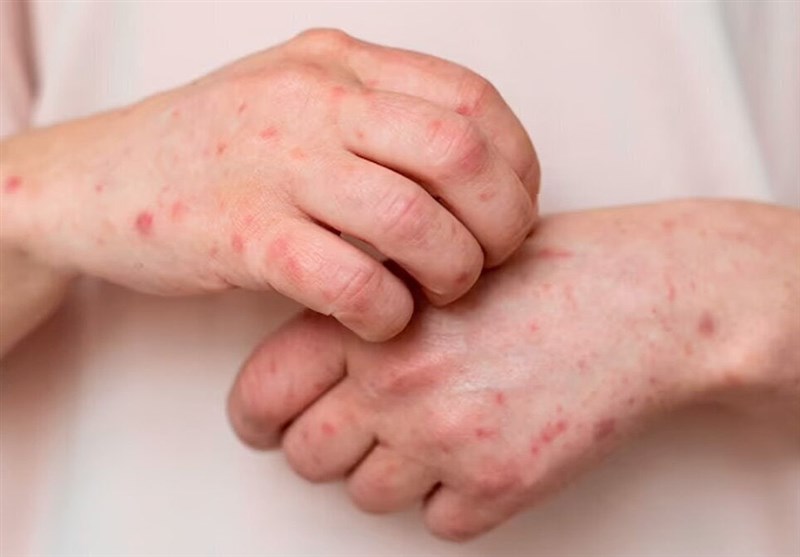 , هشدار درباره شیوع آبله مرغان؛ ضرورت آگاهی و پیشگیری