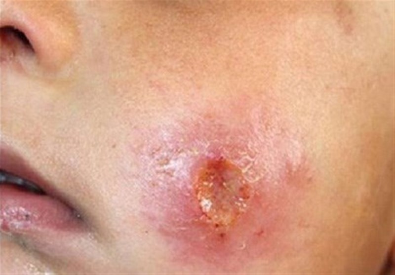 , کرمان از کانون‌های اصلی بیماری سالک در کشور