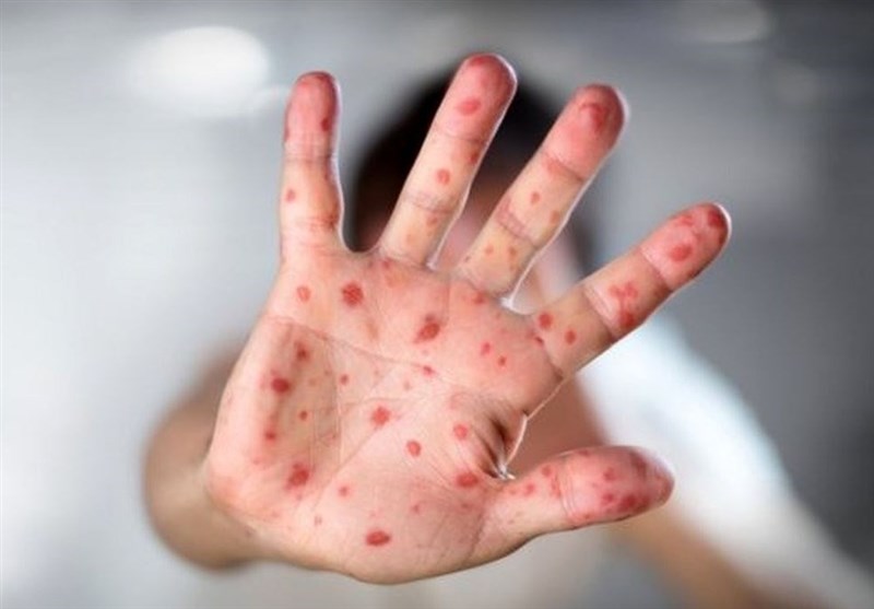 , چه کسانی بیشترین قربانی سرخک هستند؟